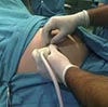 Amniocentesis y amniodrenaje
