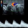 Doppler de inserción placentaria