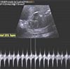 Ecocardiograma fetal estructural y funcional