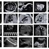 Ecografía morfológica fetal o de detalle anatómico (III nivel)