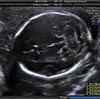 Neurosonografía fetal